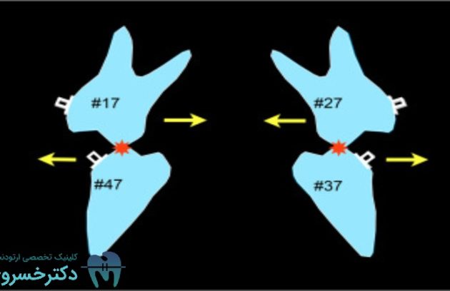 پروتکل Sendai SF در روش Surgery First