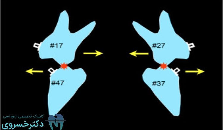 پروتکل Sendai SF در روش Surgery First
