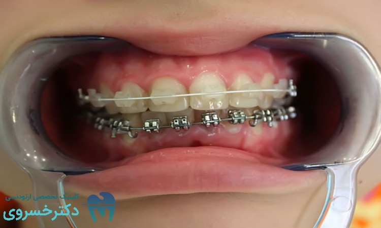 درمان صحیح ارتودنسی