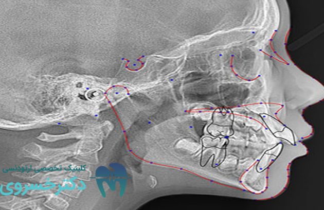 نقش سفالومتری در ارزیابی مشکلات ارتودنسی