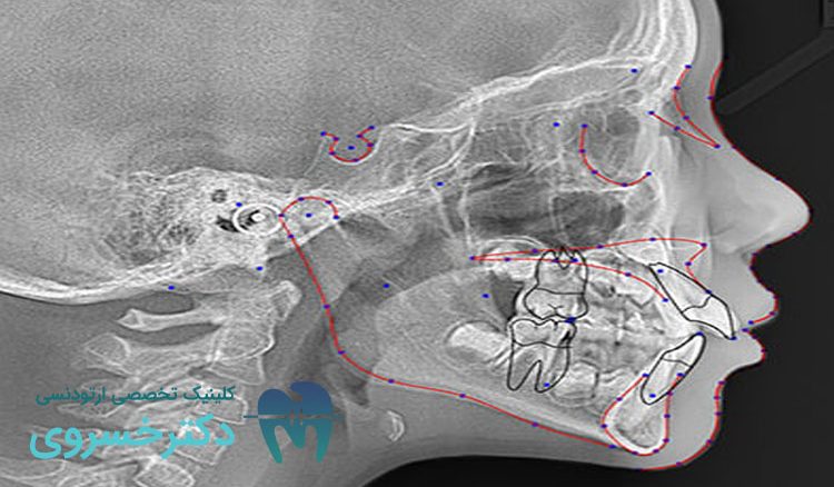 نقش سفالومتری در ارزیابی مشکلات ارتودنسی