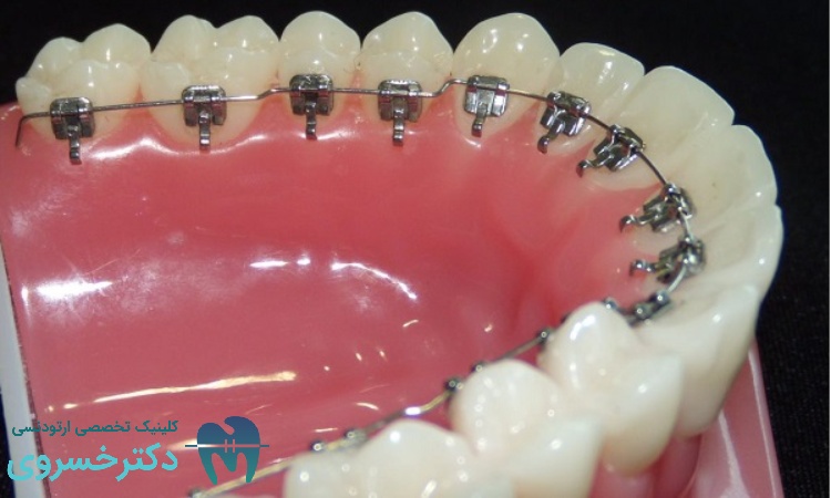 روش درمان ارتودنسی