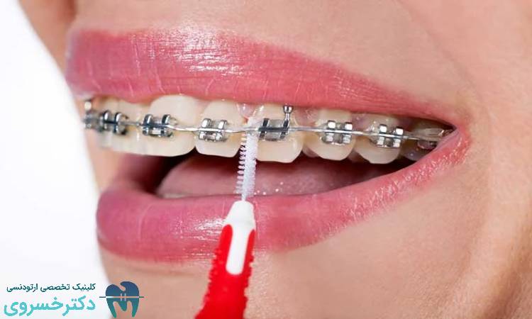 تمیز کردن ارتودنسی