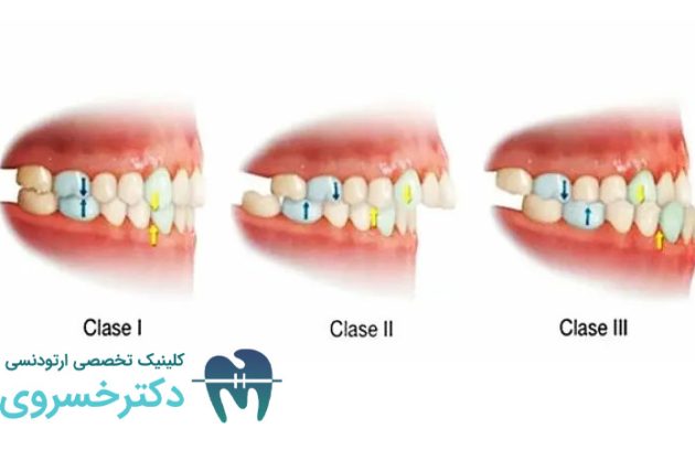 راهنمای کامل درمان مال اکلوژن کلاس II