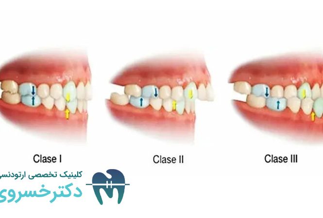 راهنمای کامل درمان مال اکلوژن کلاس II