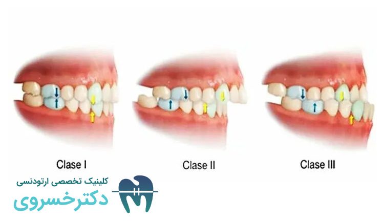 راهنمای کامل درمان مال اکلوژن کلاس II