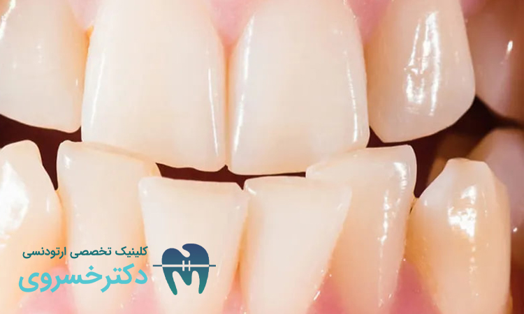 روش های درمان مال اکلوژن کلاس II