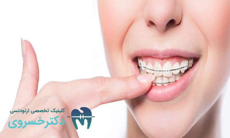 انتخاب مال اکلوژن