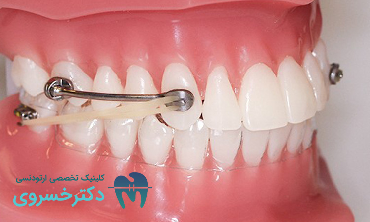انواع مال اکلوژن کلاس II