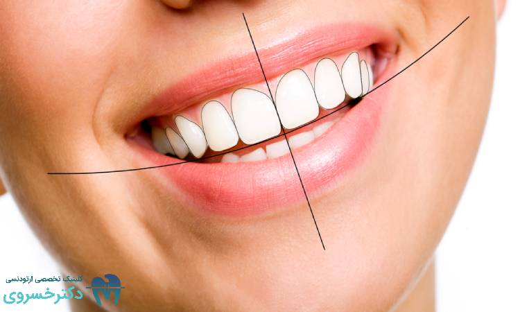 طرح لبخند ارتودنسی