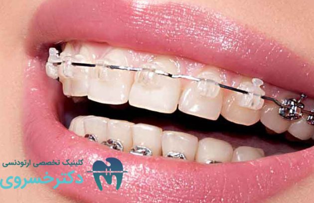 چگونه ارتودنسی لبخند هالیوودی شما را تحقق میبخشد؟