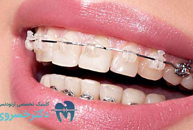چگونه ارتودنسی لبخند هالیوودی شما را تحقق می‌بخشد؟