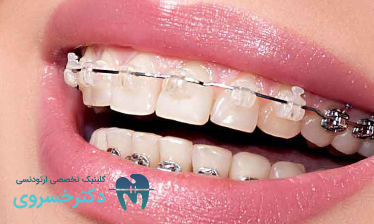چگونه ارتودنسی لبخند هالیوودی شما را تحقق می‌بخشد؟