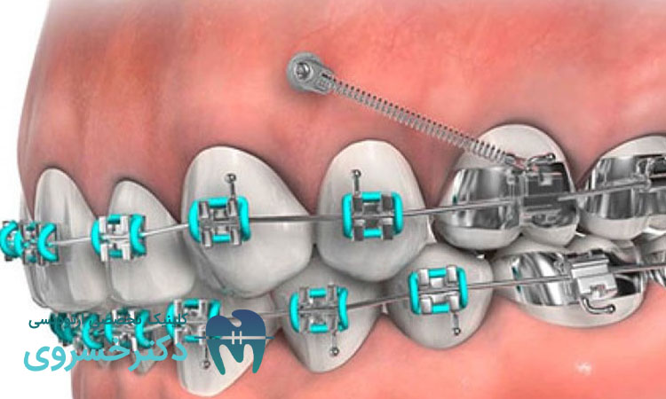 مراقبتهای لازم بعد از ارتودنسی