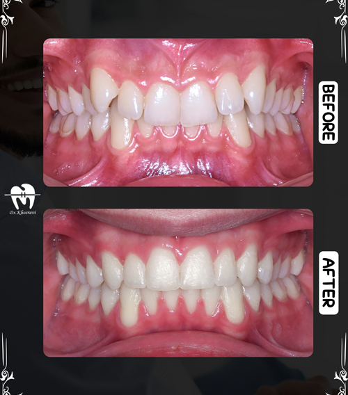 تصویر درمان قبل و بعد ارتودنسی