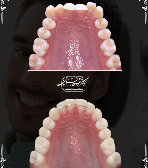 عکس قبل و بعد ارتودنسی