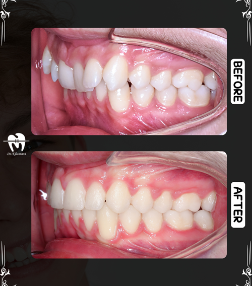 عکس درمان ارتودنسی