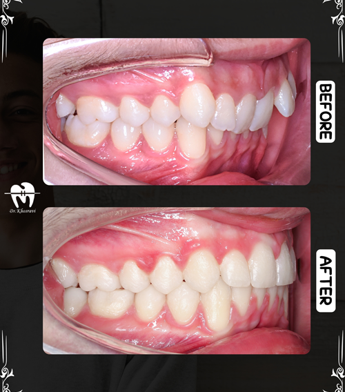 عکس درمانی ارتودنسی