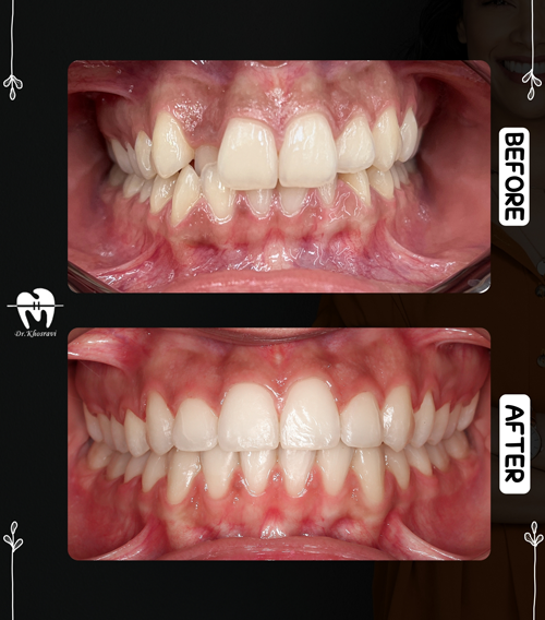 عکس درمانی قبل و بعد ارتودنسی