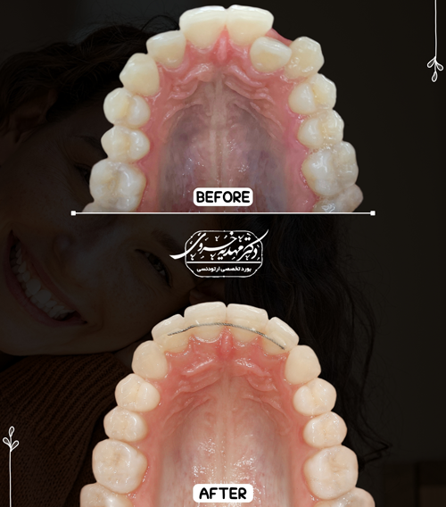 تصویر درمان قبل و بعد ارتودنسی