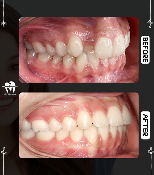 عکس درمانی قبل و بعد ارتودنسی