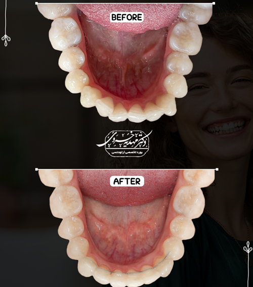 عکس قبل و بعد ارتودنسی