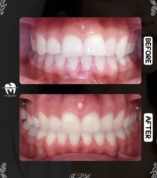 تصاویر قبل و بعد ارتودنسی