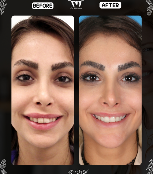 عکس قبل و بعد ارتودنسی