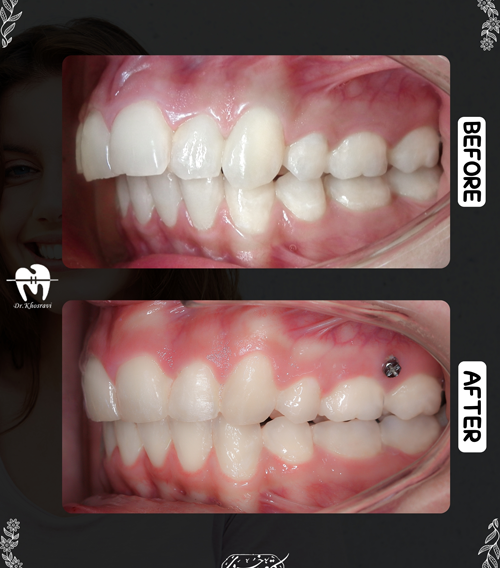 تصاویر قبل و بعد ارتودنسی