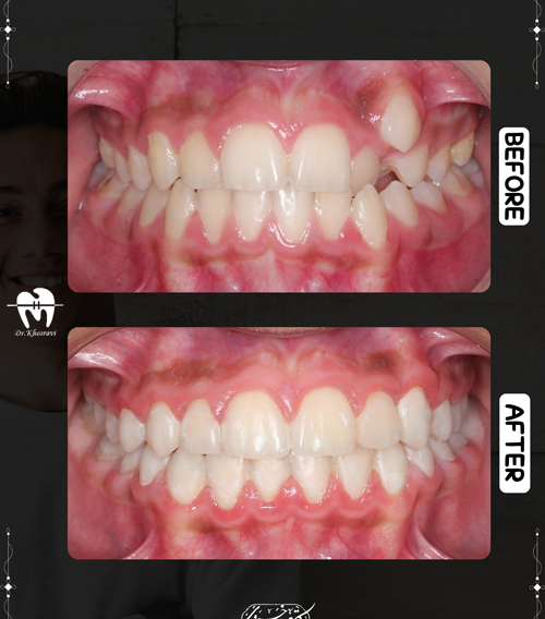عکس قبل و بعد ارتودنسی