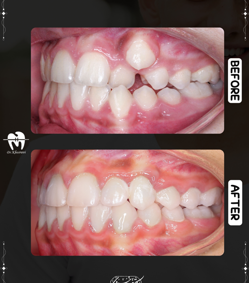 تصویر قبل و بعد ارتودنسی