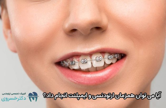 انجام همزمان ارتودنسی و ایمپلنت