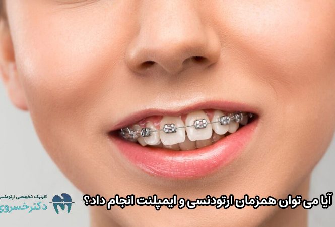 انجام همزمان ارتودنسی و ایمپلنت