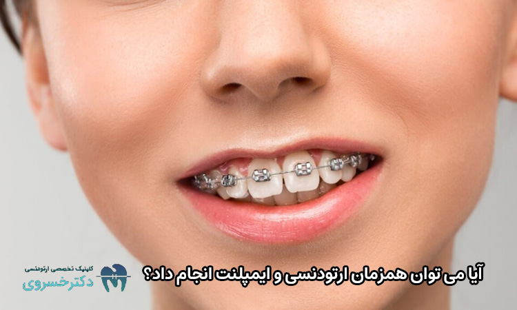 انجام همزمان ارتودنسی و ایمپلنت