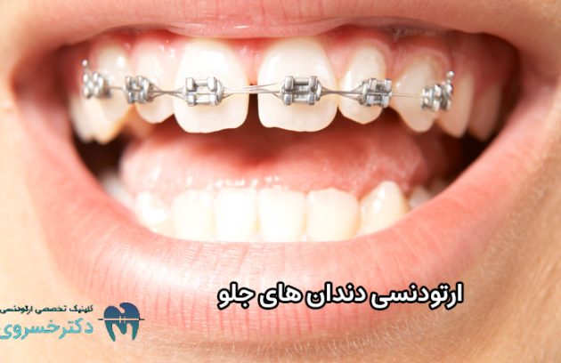 ارتودنسی دندان های جلو