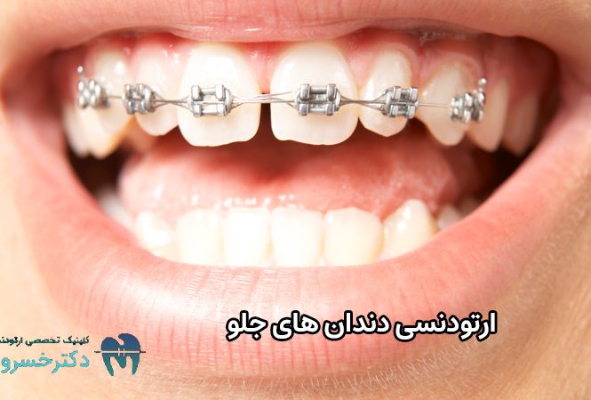 ارتودنسی دندان های جلو