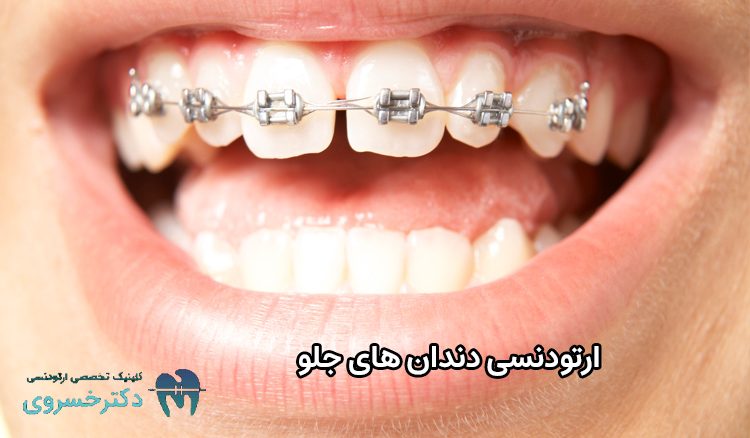 ارتودنسی دندان های جلو