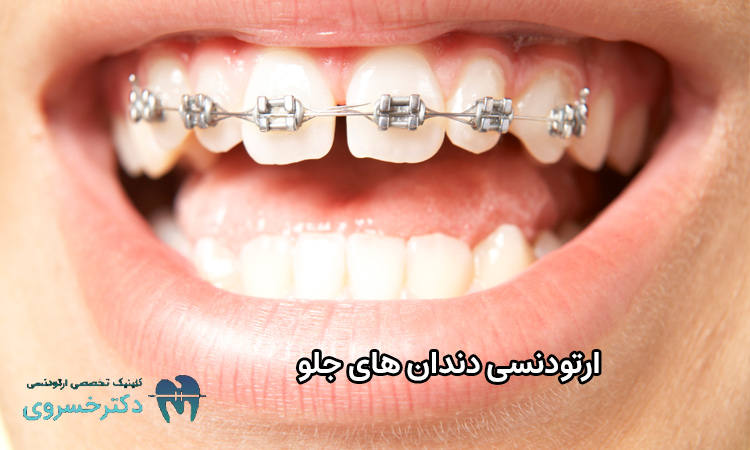 ارتودنسی دندان های جلو