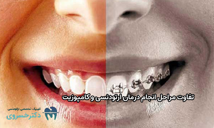 تفاوت مراحل درمان ارتودنسی و کامپوزیت