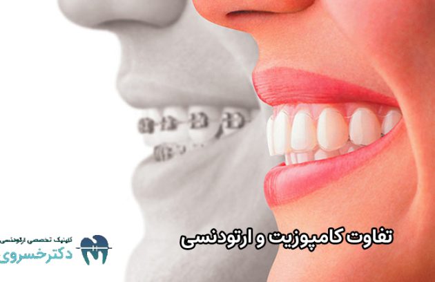 تفاوت کامپوزیت و ارتودنسی