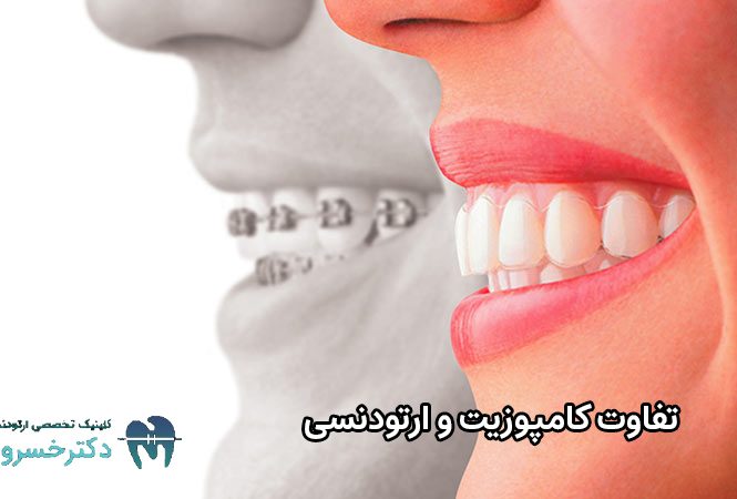 تفاوت کامپوزیت و ارتودنسی