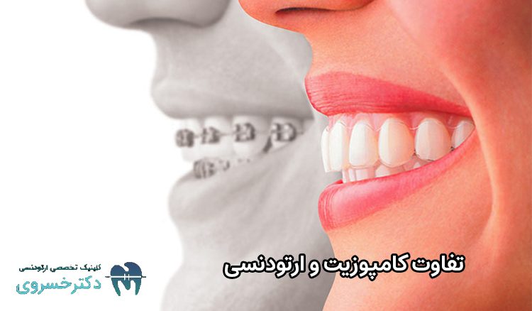 تفاوت کامپوزیت و ارتودنسی
