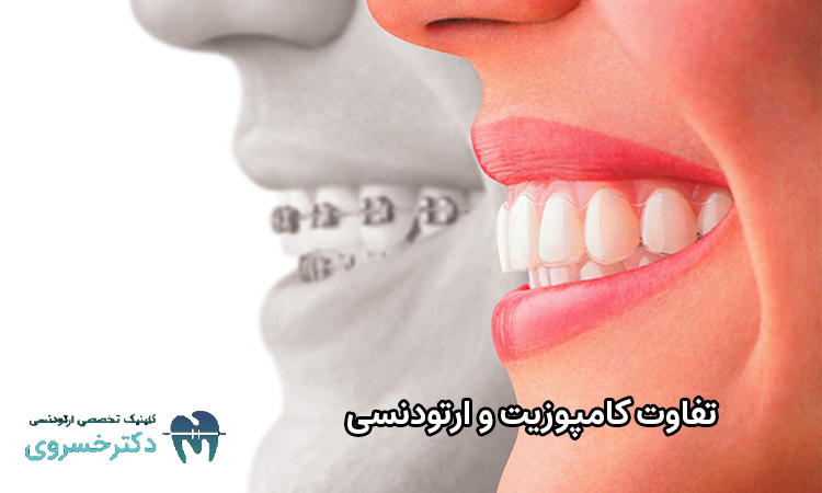 تفاوت کامپوزیت و ارتودنسی