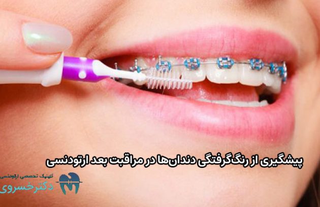 مراقبت های بعد ارتودنسی چیست؟