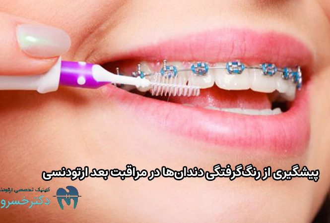 مراقبت های بعد ارتودنسی چیست؟