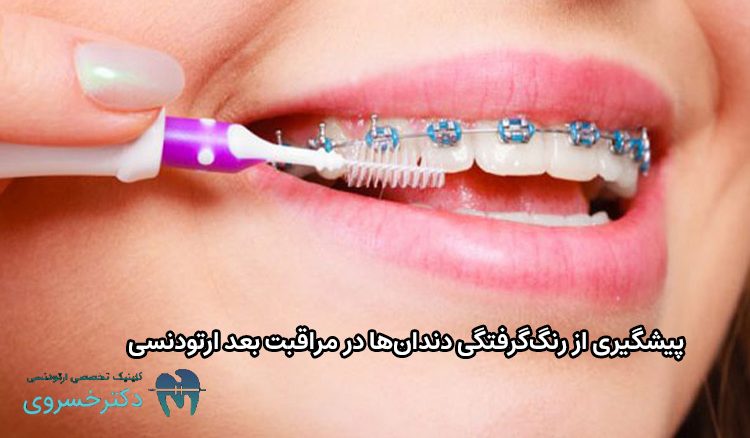 مراقبت های بعد ارتودنسی چیست؟