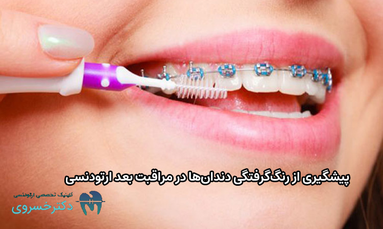مراقبت های بعد ارتودنسی چیست؟