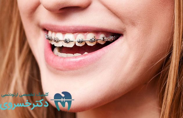 میزان طول کشیدن درد ارتودنسی