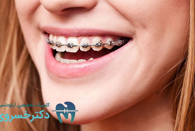 میزان طول کشیدن درد ارتودنسی