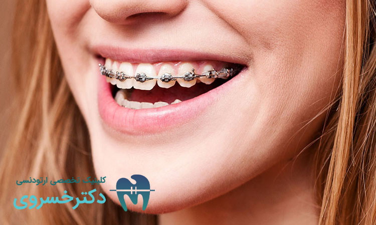 میزان طول کشیدن درد ارتودنسی